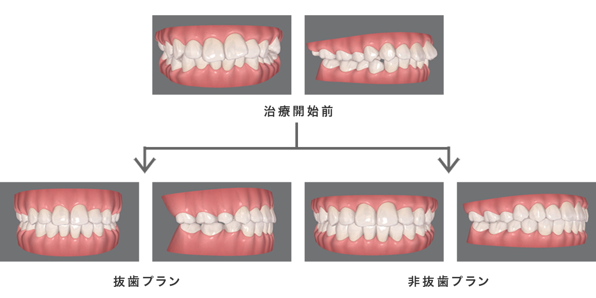 マウスピース矯正のイメージ写真