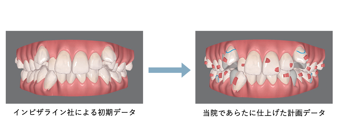 マウスピース矯正のイメージ写真