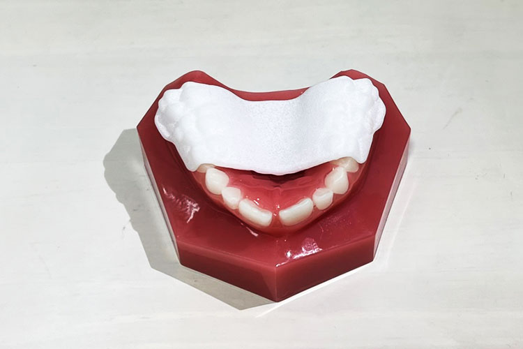 お子さまの矯正治療に新しいソリューションが登場のインビザライン・パラタル・エクスパンダーイメージ写真